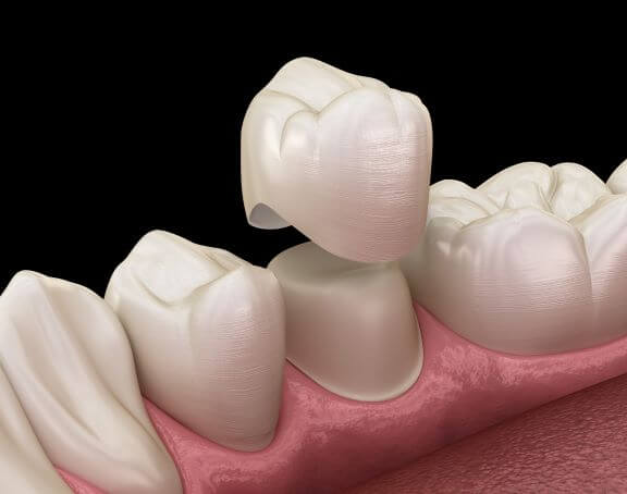 dental crown over tooth