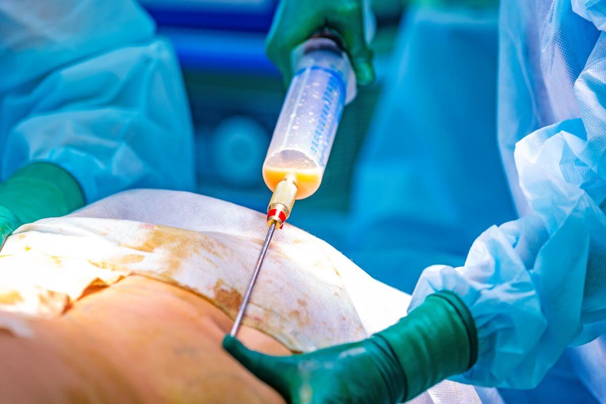 liposuction in turkey