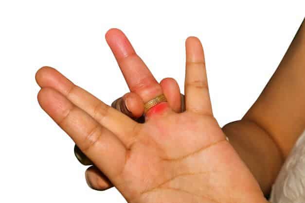 ring finger sore with irritation